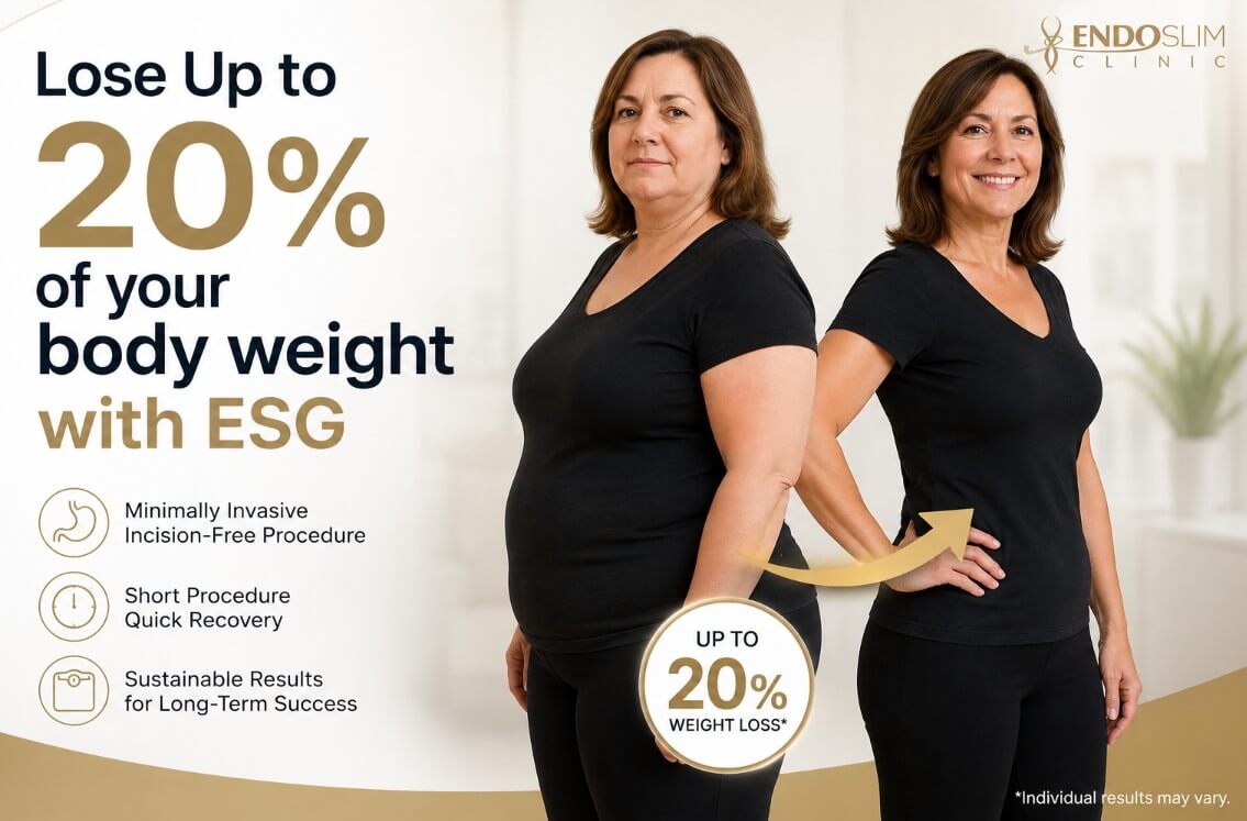 Before-and-after illustration showing a patient who achieved up to 20% body weight loss with Endoscopic Sleeve Gastroplasty (ESG), an incision-free weight loss procedure, featuring the EndoSlim Clinic logo.